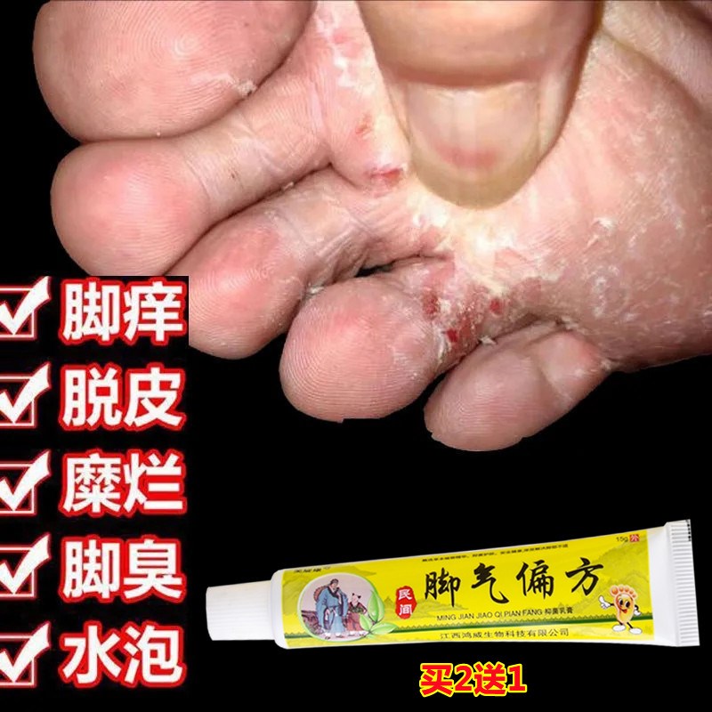 脚藓一次净烂脚丫药脱皮糜烂脚趾缝烂痒开裂脚趾头痒脚上长水泡痒