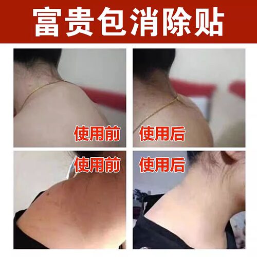 富贵包消除神器修覆颈部大椎鼓包肩颈脖子不适酸痛祛鼓包堵塞膏贴