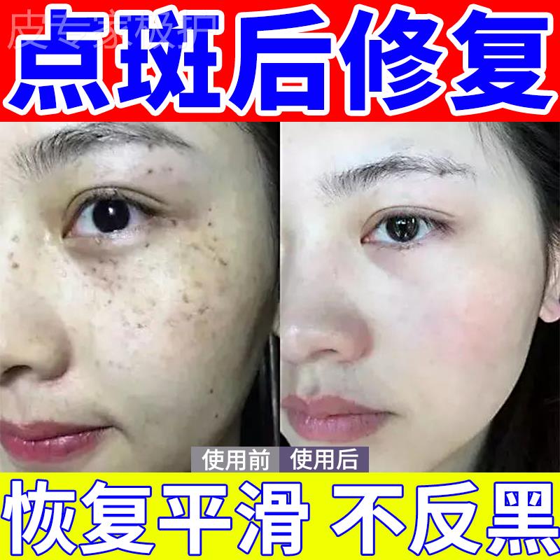 点斑点痣后修复液敏感肌去痘印凹坑退红激光祛斑痣术后反黑专用膏