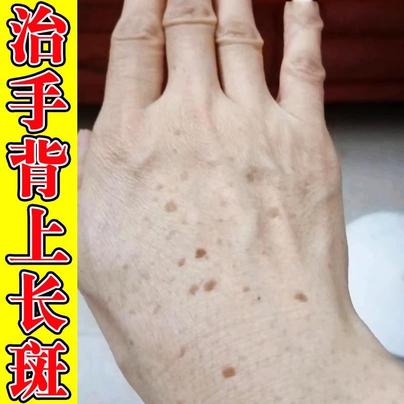 手背上的老年斑祛除祛老年斑专用手上脸部黄褐斑日晒斑皮肤上黑斑