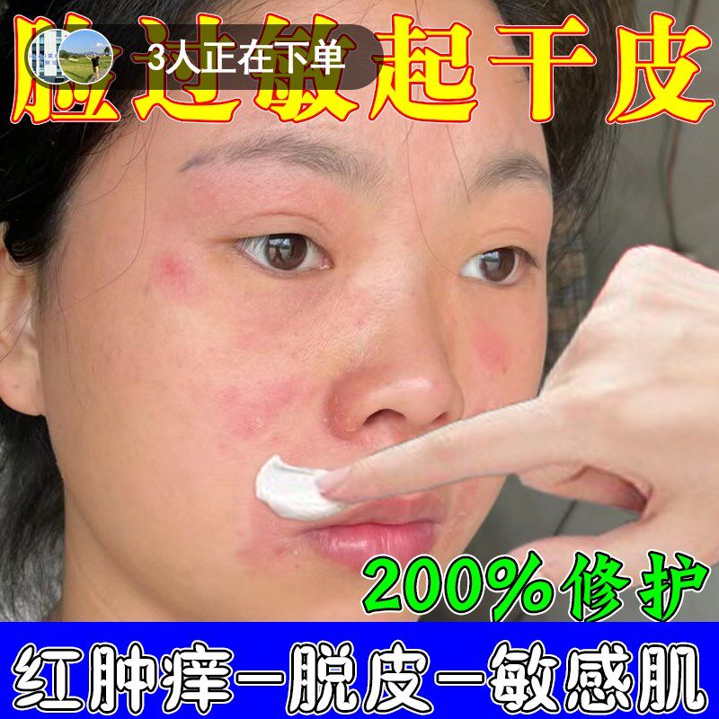 过敏皮肤修复脸部外用脸上干燥起皮泛红发痒起小疙瘩痘痘专用软膏