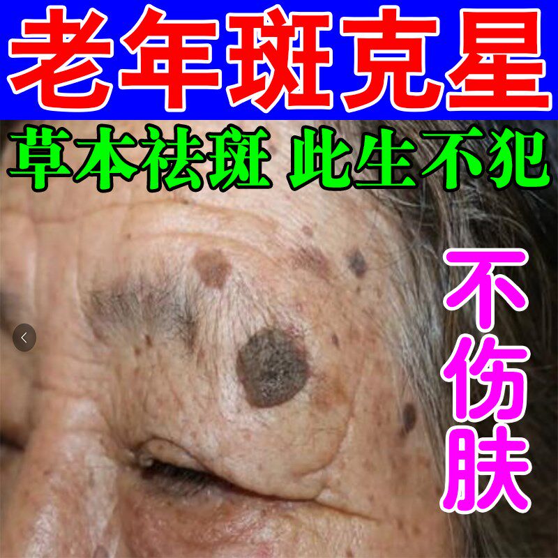 去老年斑的药膏脸上黑褐色斑点去黄褐斑雀斑妊娠斑老年斑去黑色素