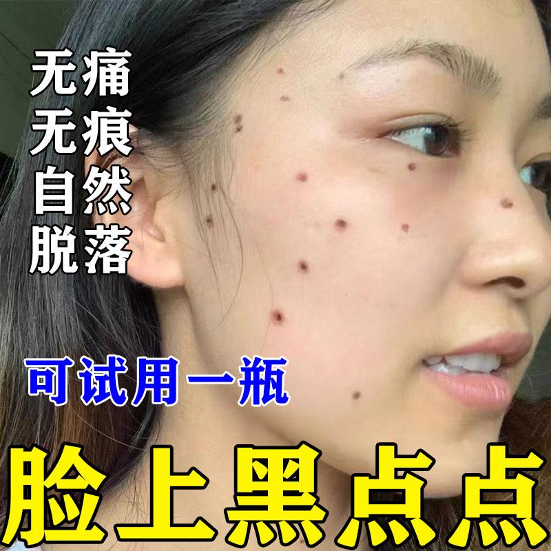 去黑点点痦子扁平圆形小疙瘩肉钉无痛无痕学生手足通用外涂温和膏