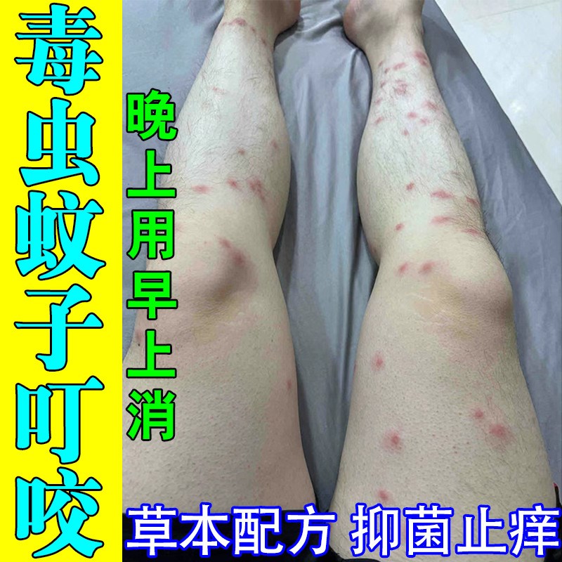 蚊虫叮咬止痒药膏跳蚤蚊子臭虫叮咬皮肤过敏快速消包专用膏