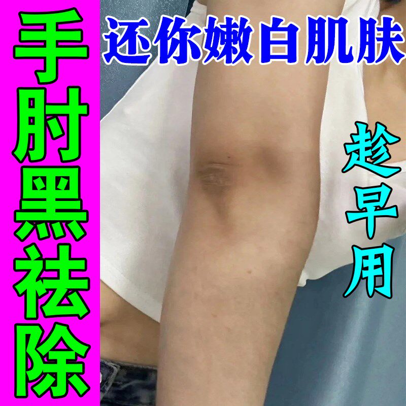 胳膊肘去黑去死皮手关节去手肘黑黑色素沉淀去除死皮黑棘皮症变白 - 实物图