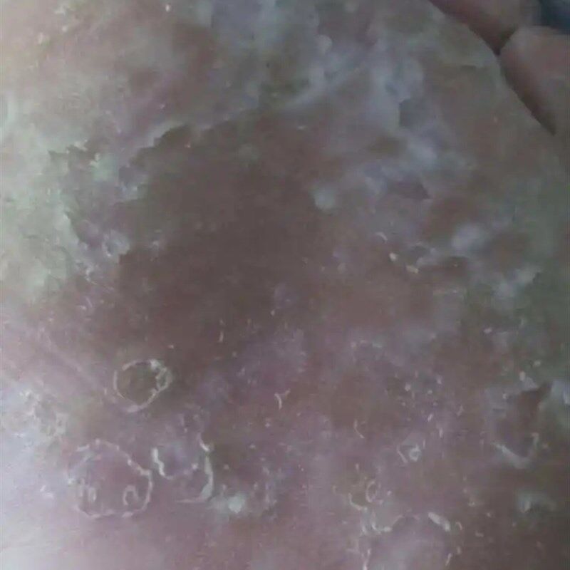 脚脱皮起泡去死皮痒脚底干燥开裂泡脚护理手脱皮脚丫软膏