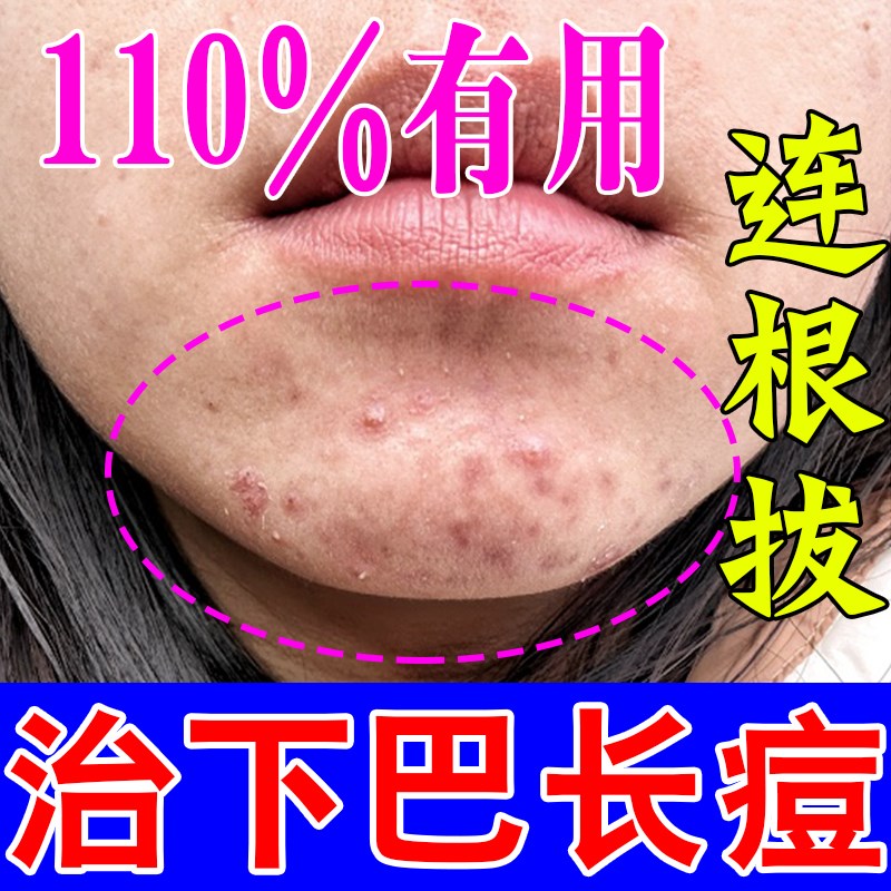 下巴反复长痘调理内分泌失调长痘硬块脓包去痘印修复淡化痘印药膏