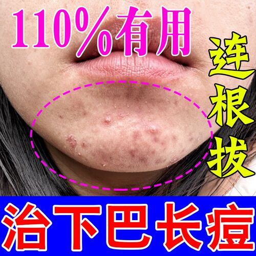下巴反复长痘调理内分泌失调长痘硬块脓包去痘印修复淡化痘印药膏