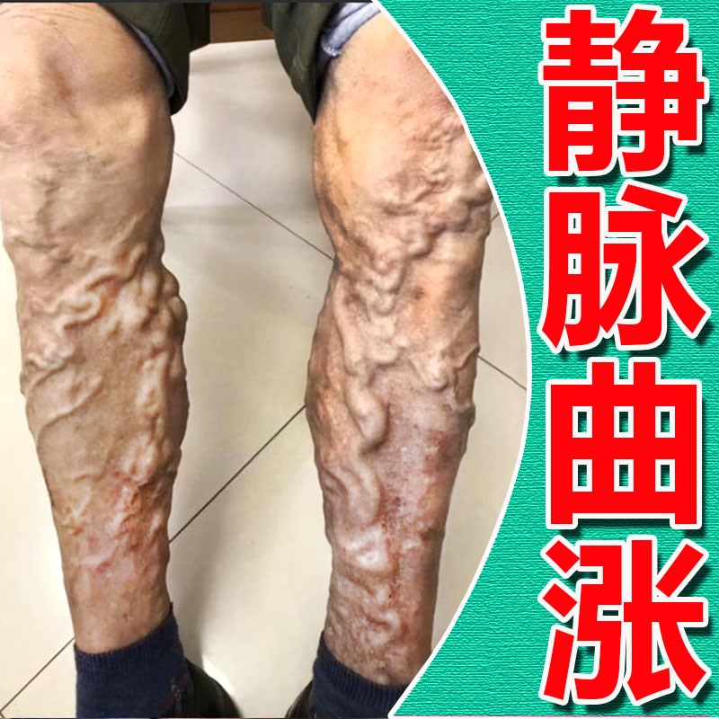 【当晚见校】静脉曲涨特膏效抹平青筋凸起老烂腿冷敷凝胶