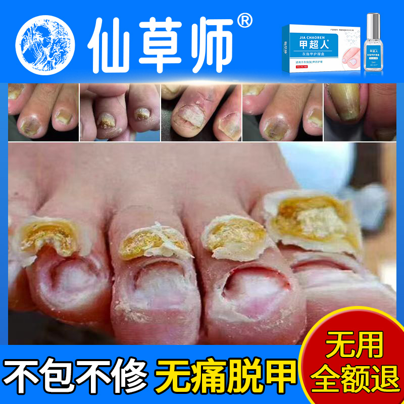 无痛灰指甲专用脱膏液沟炎