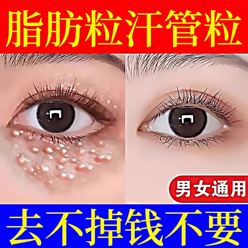 脂肪粒去除神器汗管瘤眼