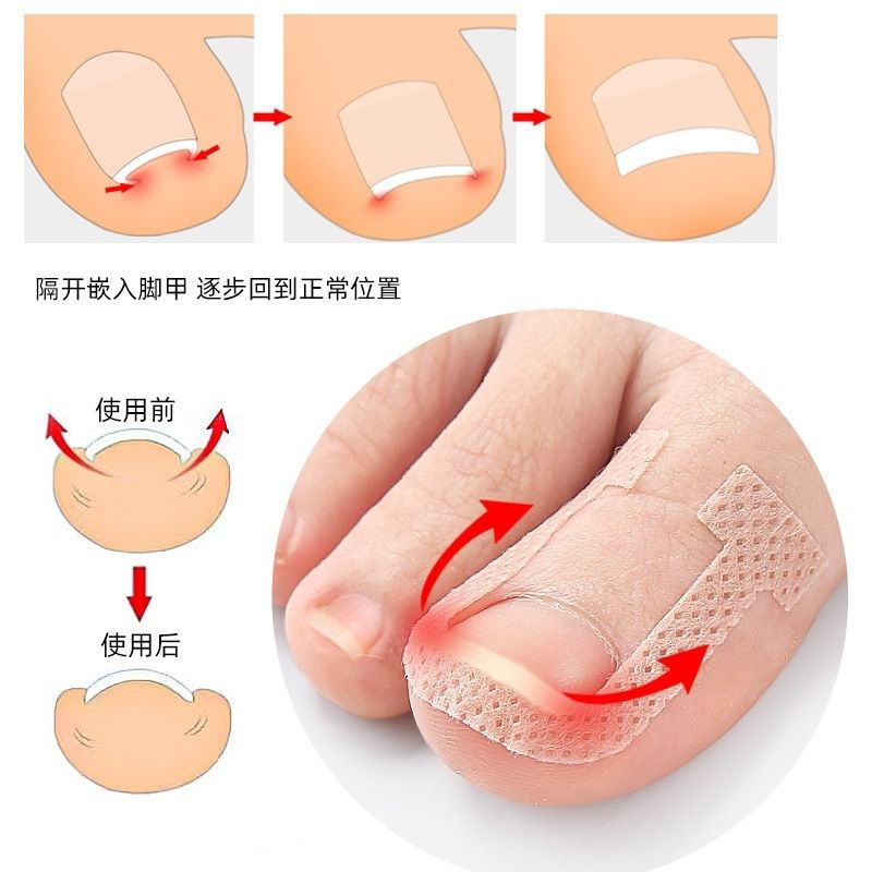 脚指甲盖矫正器U型贴片锤