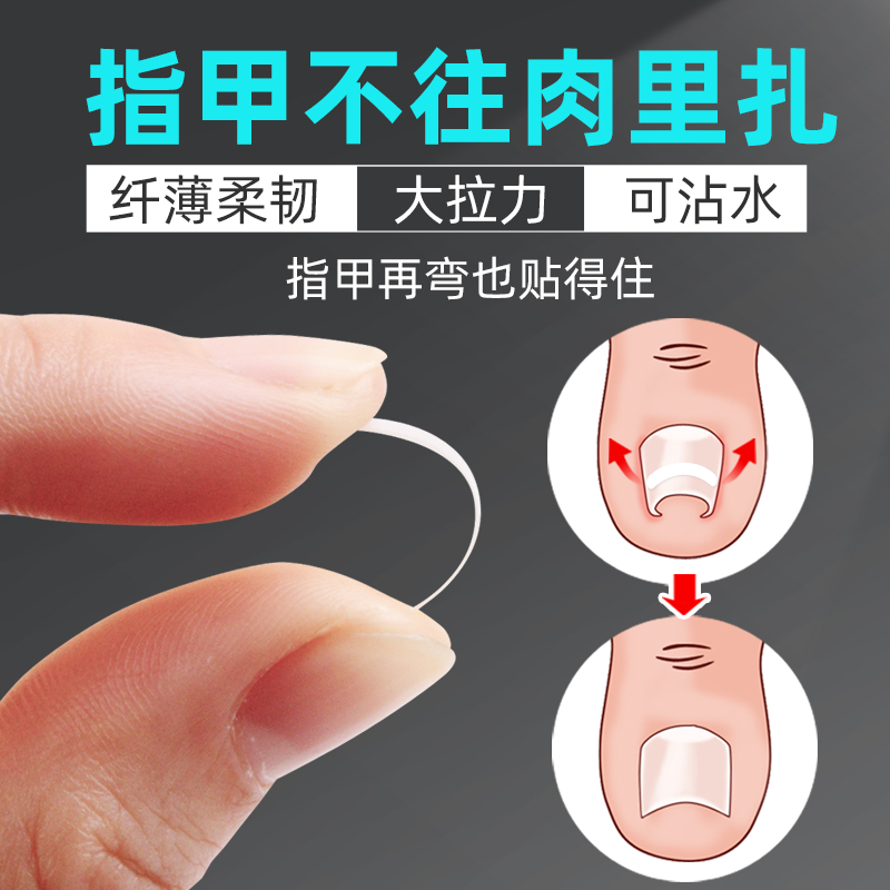 脚医生正甲贴甲沟嵌甲炎拉拉脚指甲趾甲专用纠正矫正器贴片长肉里