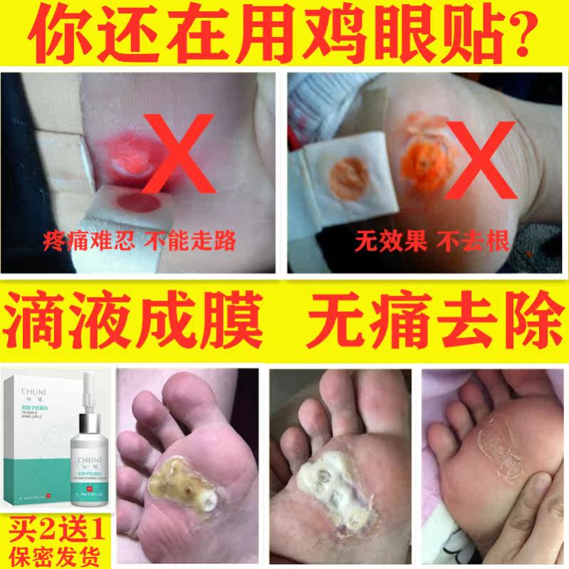 鸡眼膏去根老茧鸡眼贴软膏正品鸡眼去根瘊子水杨酸用刀脚垫苗疆|msdalam kategori Penyetempatan perkhidmatan kehidupan, Perkhidmatan kesihatan, 健康服务, 在线问诊, 内容分答 - dari Buy2taobao.com untuk memberikan perkhidmatan ejen Taobao profesional membeli