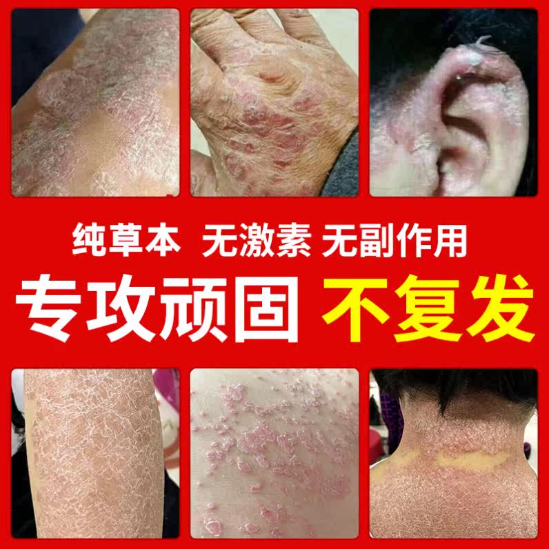 皮肤病头皮藓药抑制真菌大腿内侧真菌感染牛皮癣药水治疗干疮的药