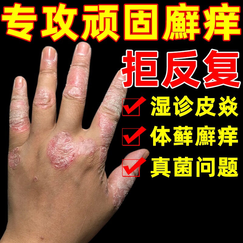 治疗头皮屑的药治头皮屑的药牛皮癣洗头膏脱皮药膏治干疮的药外用