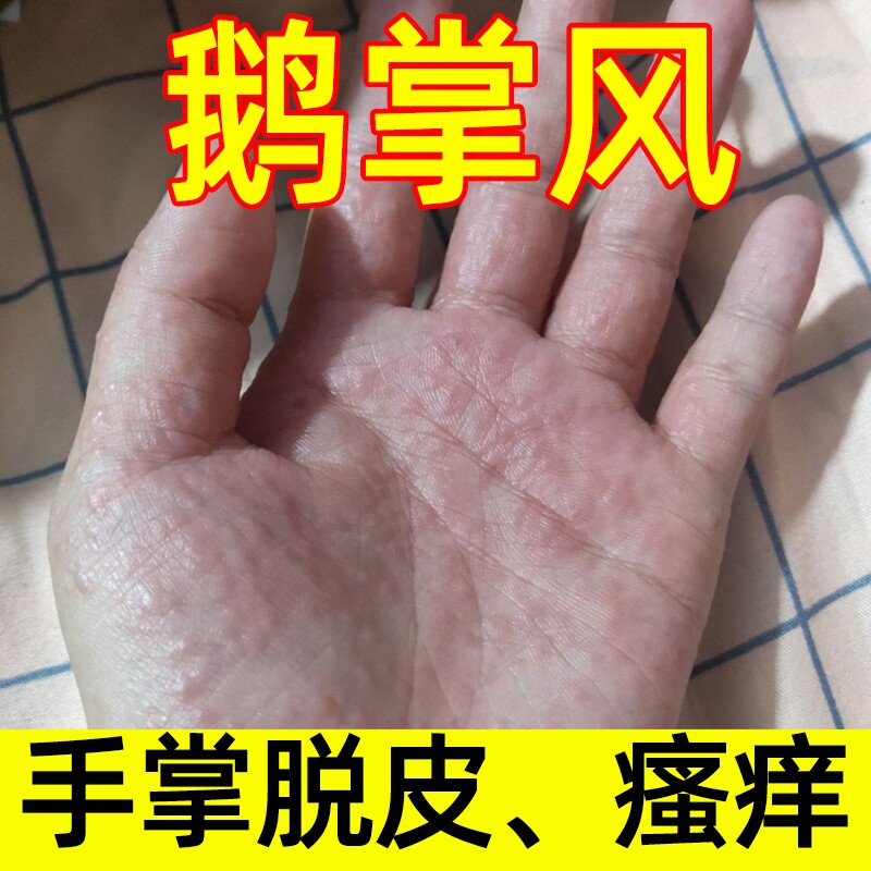 治疗手脱皮的药膏治癣药膏抑制真菌苗中医药膏汗状疱疹手上小水泡