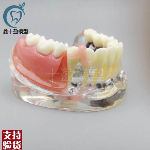牙科口腔教学种植与修复模型3颗钉模型微型种植医患沟W通M6006