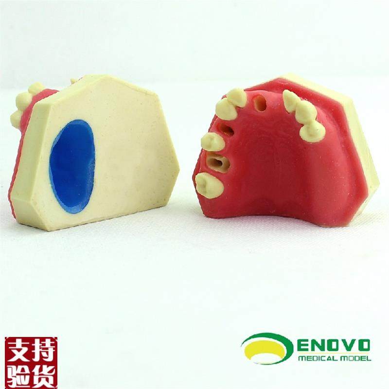 ENOVO颐诺口腔即刻种植练习操作模型上颌M骨上颌窦牙列缺失种植体,文具电教/文化用品/商务用品,教学标本/模型,淘宝优惠券,粉丝福利购,淘宝优惠卷