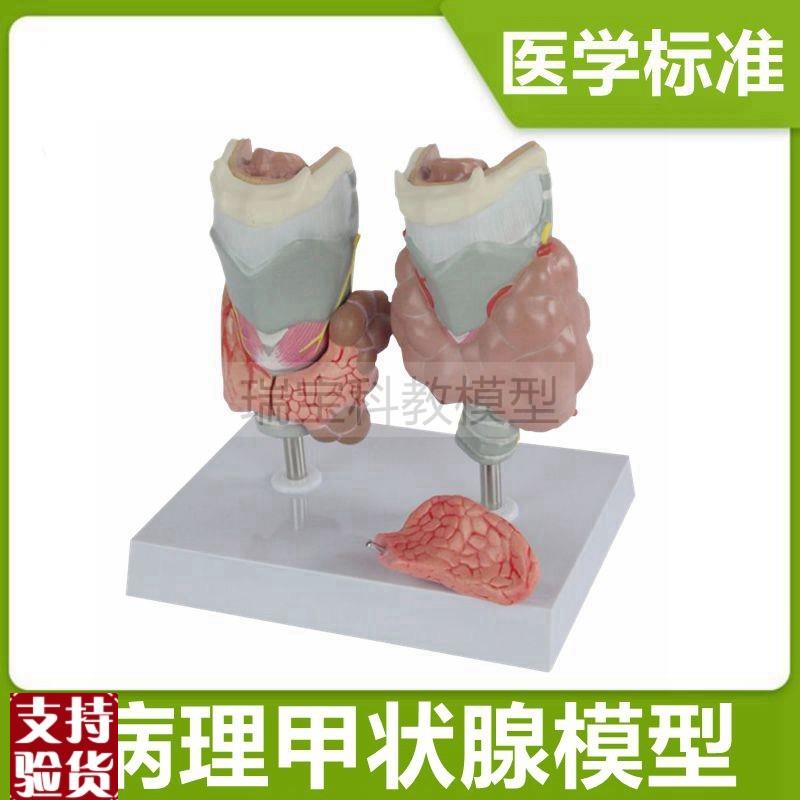 病理甲状腺模型内分泌器官临床医患G沟通医药礼品大囊肿医用教学