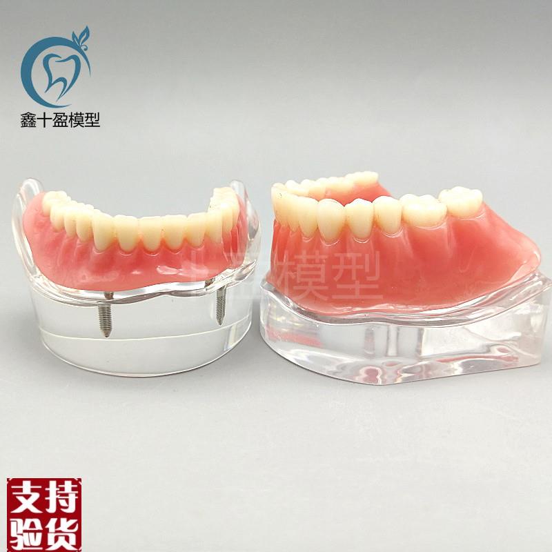 牙科教学模型齿科修复模型医患沟通下半口O2颗钉种植修复包邮