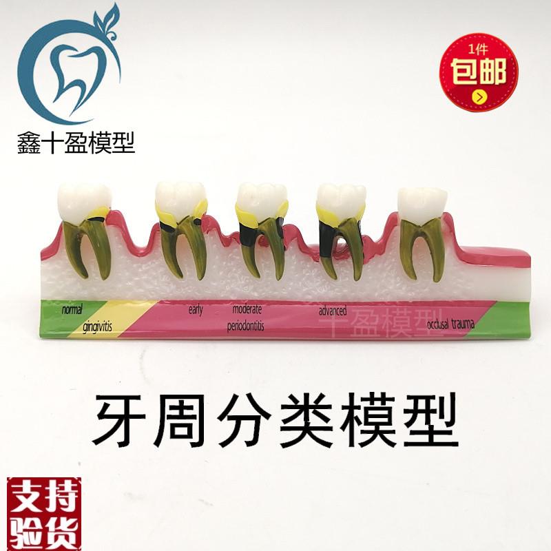 牙科材料a龋齿演变模型牙周分解教学讲解沟通饰品