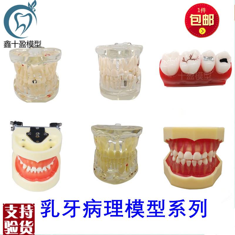 牙齿模型乳牙恒儿童病理牙模型乳B牙替换儿牙模型教学窝沟封闭模