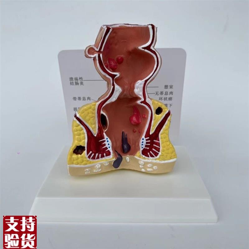 人体直肠模型肛管裂开痔内外突出瘘D管消化道结肠大肠医患病理沟