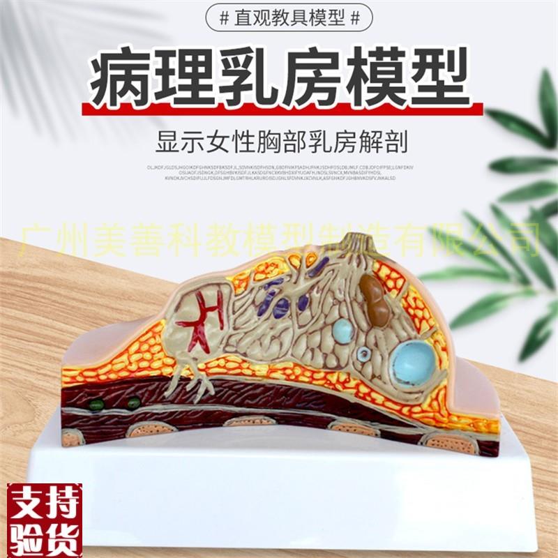 病态女性乳房模型病理乳腺解剖模型女性生Q殖科普教育教学健康