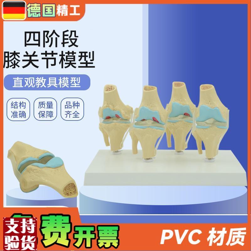 德国】人体膝关节模型正常与病理对比教具医药礼T品医患沟通道具