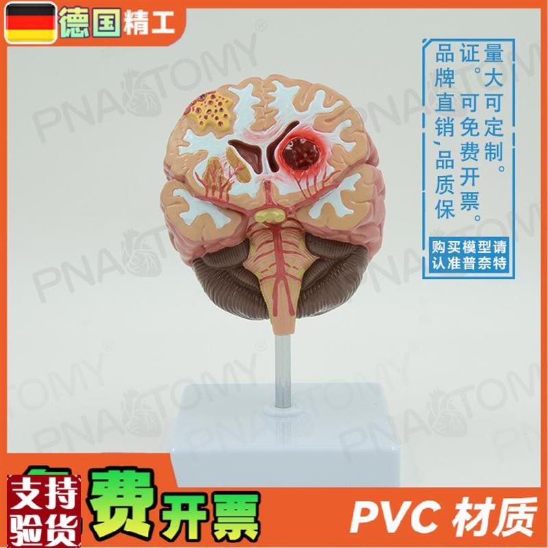 德国】人脑病理解剖模型q脑geng大脑疾病血管堵塞标本教学脑科神