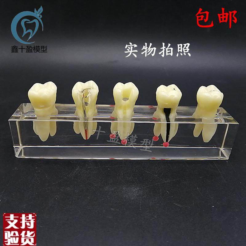 口腔教学b模具水晶根管治疗模型可拆修复牙冠龋齿蛀牙病理M4012