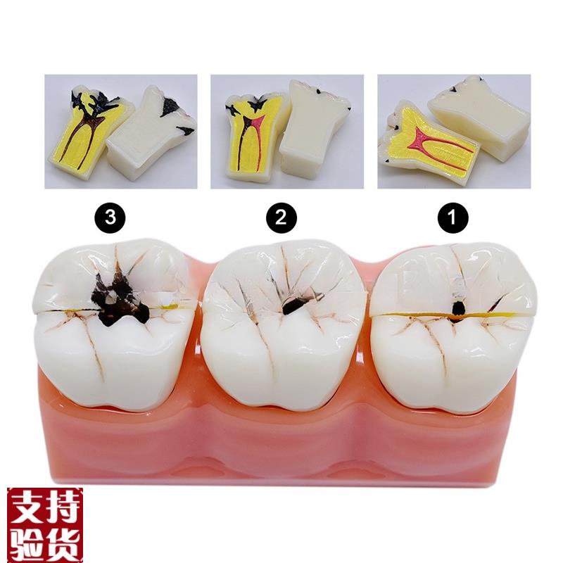 牙科医患沟通病理牙模型窝沟封闭种植龋齿根管龋齿病Z理分解模型