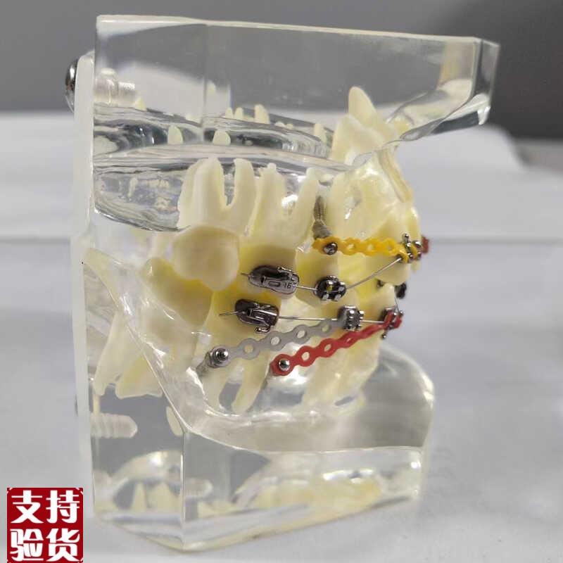 透明正畸撮合矫正模型透明水晶y托槽展示结扎丝托槽正畸带支抗钉