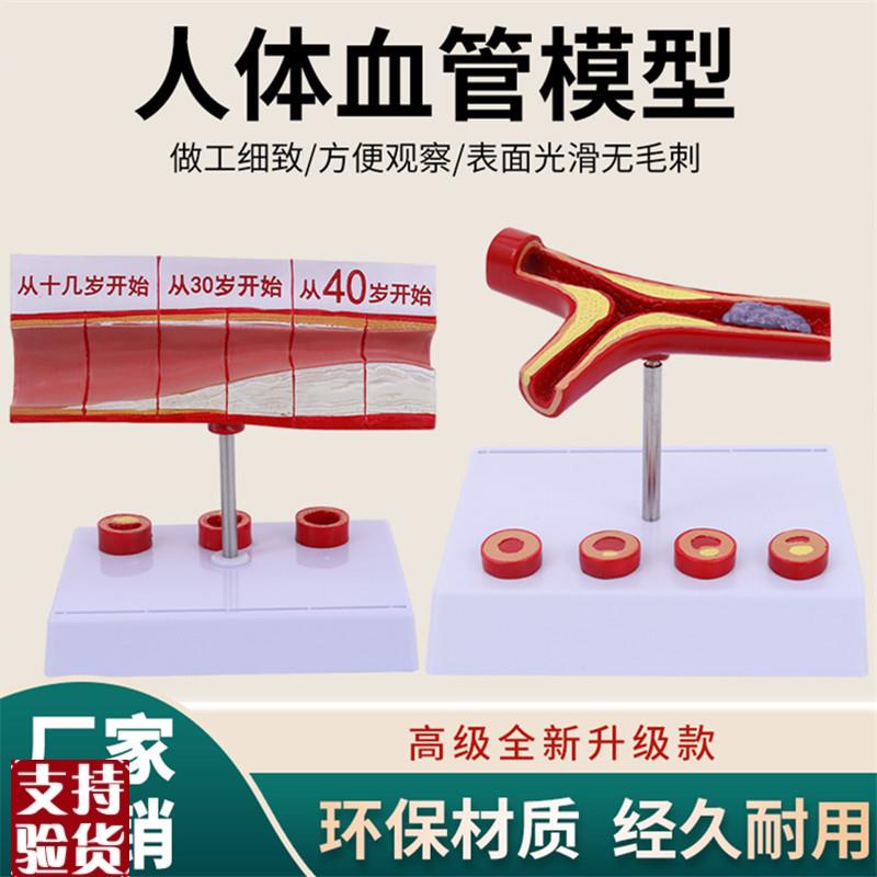堵塞心血管模型关节血栓血液浓度脂肪病理粥样硬化人.体解剖教具