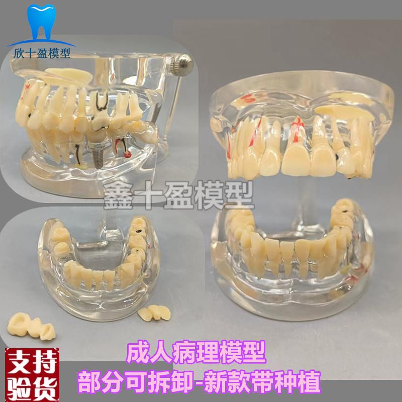 牙科牙齿病理模型成人o全口牙模型牙模医患沟通教育教学种植修复C