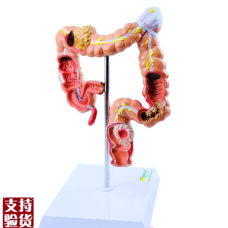 ENOVO颐诺h人体大肠疾病展示模型结肠直肠道病变症状消化系统疾病,文具电教/文化用品/商务用品,教学标本/模型,淘宝优惠券,粉丝福利购,淘宝优惠卷