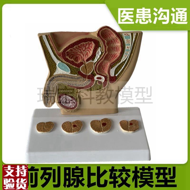 男性前列腺模g型变大尿道狭窄男科医患沟通临床医药礼品生殖泌尿