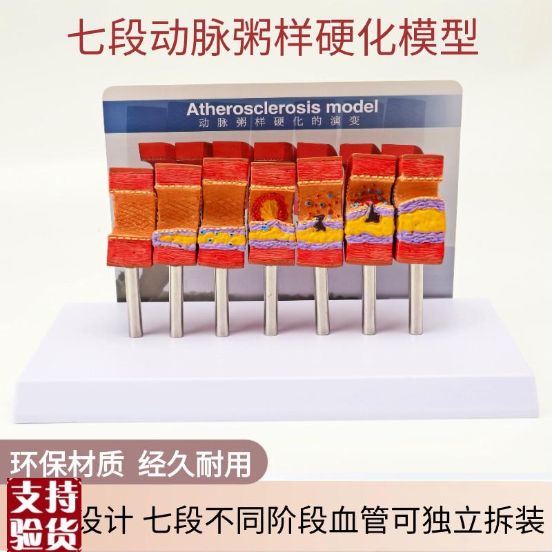 动脉粥样硬化模j型血管血栓栓塞模型动脉血管人体医用医学教学模