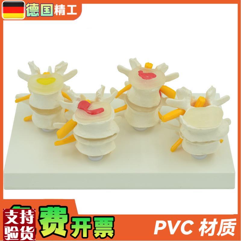 德国】4阶段病变腰椎模型y人体骨骼解剖椎体医学教学器材