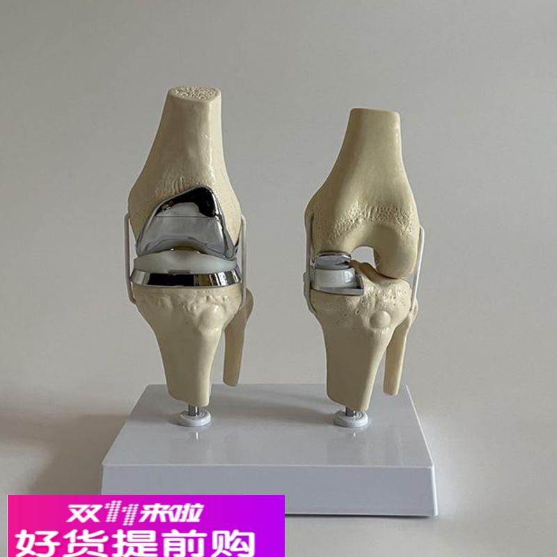 人工膝关节模型膝盖置换仿真假体半月板软骨胫骨平台髋关节替换术