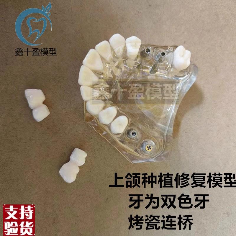 牙科种植模型2011上颌种y植解说义齿修复烤瓷连桥种植钉模型