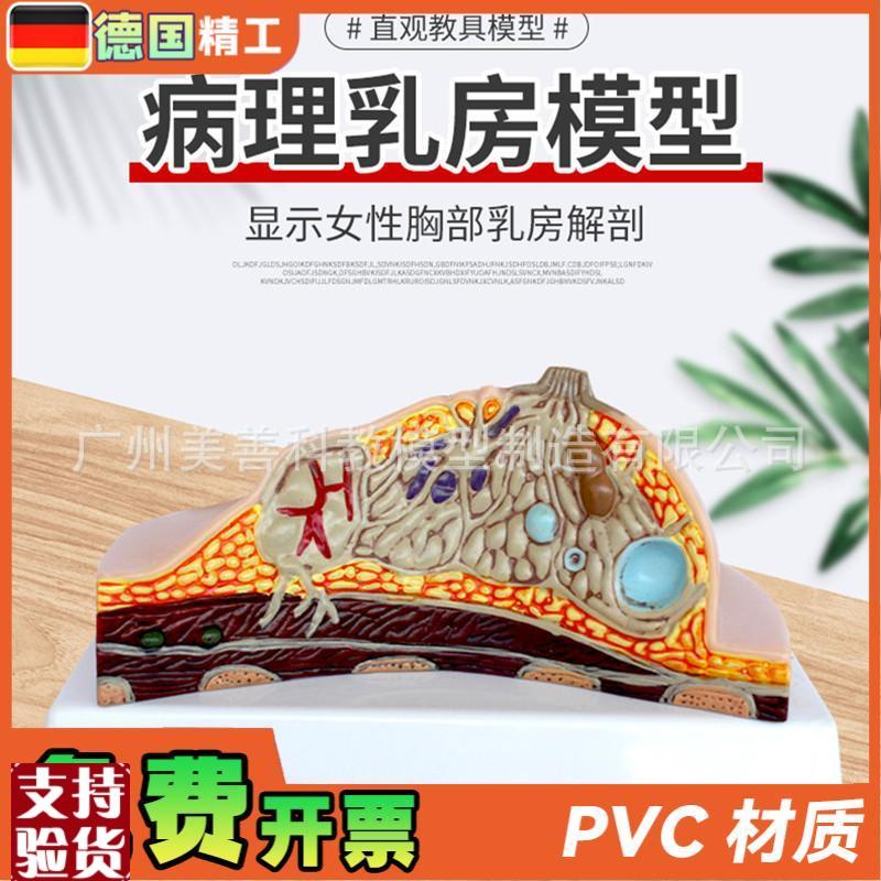病理乳房模型乳房病变模型乳房解D剖模型乳房常见疾病乳房模型