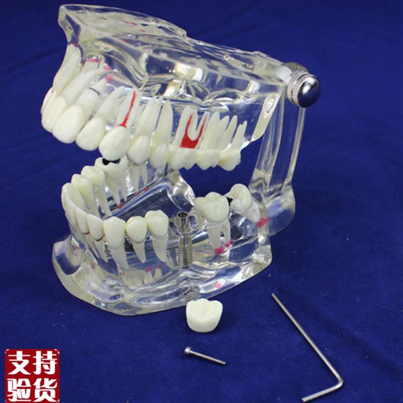 ENOVO正品h牙齿模型口腔牙齿科疾病种植修复模型口腔病理模型
