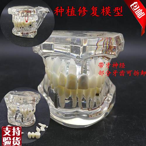 牙科材料连桥g修复体模型病理牙模型可拆卸活动牙种植体包邮