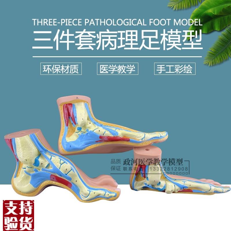 足解剖模a型扁平足模型弓形足模型足解剖模型型病理足模型包邮