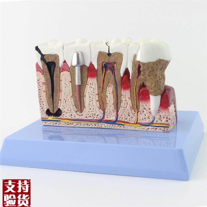 ENOVO颐诺牙齿模型口腔u牙齿科种植模型口腔病理模型口腔医院医患,文具电教/文化用品/商务用品,教学标本/模型,淘宝优惠券,粉丝福利购,淘宝优惠卷