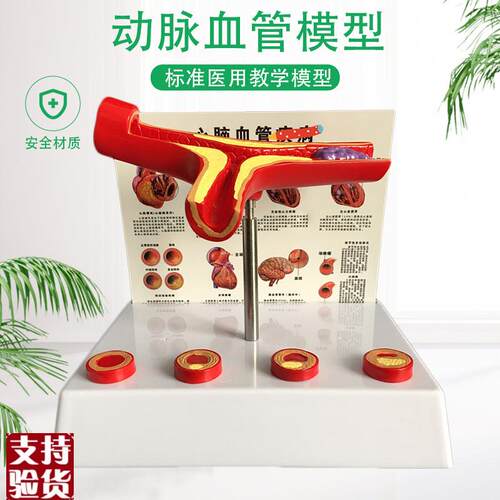 血栓模型人c体血管模型动脉静脉循环系统教具医用血栓教学医患模