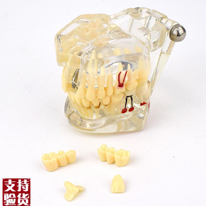ENOVO颐诺口腔模型齿科种植阻生齿牙体牙髓口腔T教学马里兰桥瓷贴