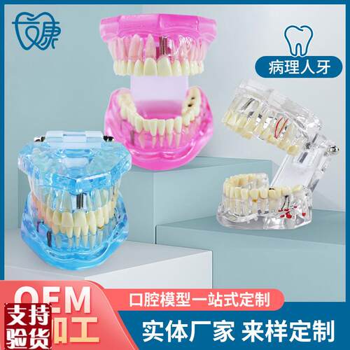 牙齿模型病理修复可拆卸正畸口腔病理牙模P型牙科医患活动沟通